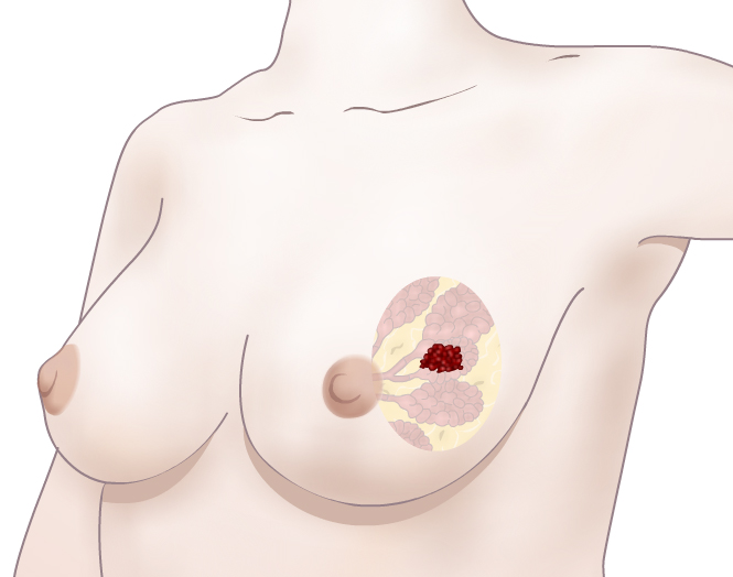 Breast Cancer