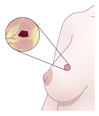 Intro to Breast Cancer