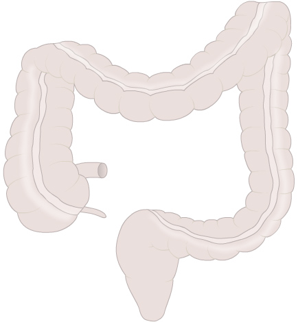 Colon Cancer