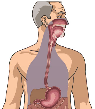 Esophageal Cancer