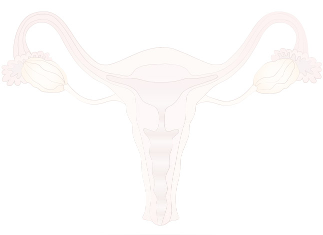 Ovarian Cancer