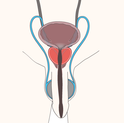 Prostate Cancer