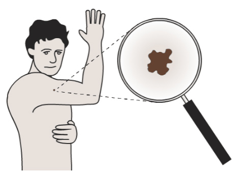 Skin Cancer